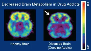 Brain_metabolism_and_drug_addiction.webp
