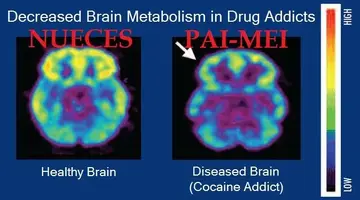 Brain_metabolism_and_drug_addiction.webp