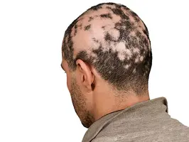 Alopecia-Areata.webp