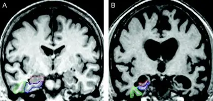 brain-regions-alzheimer-mri.webp