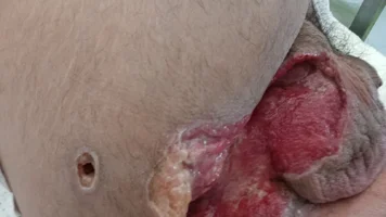 explosion escrotal.webp