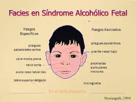 Facies+en+Síndrome+Alcohólico+Fetal.webp