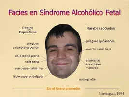 Facies+en+Síndrome+Alcohólico+Fetal.webp