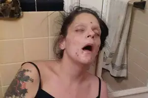 Woman-Shares-Graphic-Photos-to-Show-Addiction.webp