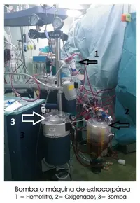 4.6.5.-bomba-extracorporea.webp