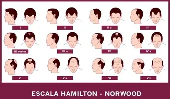 ESCALA-HAMILTON-NORWOOD-ALOPECIA-CENTROS-BELTRAN.webp