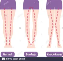 difference-types-of-legs-angles-and-knees-vector-illustration-normal-bowlegs-knock-knees-2BD9...webp