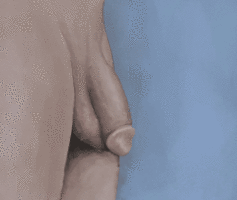 250px-Penile_implant_in_action.gif