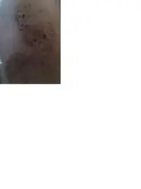 Herida 1 - copia.webp