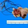 Teratoma
